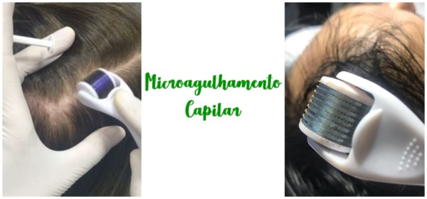 Microneedling capillaire - Qu'est-ce que c'est + Résultats avant et après !