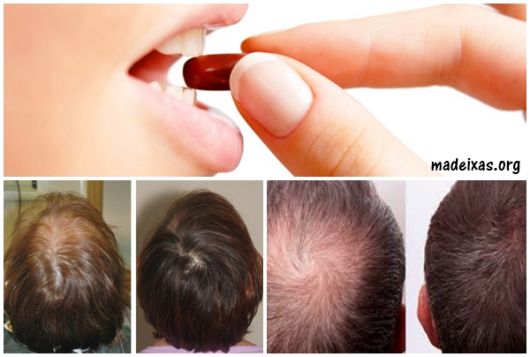 Top 4 des remèdes contre la perte de cheveux – Liste des meilleurs produits !